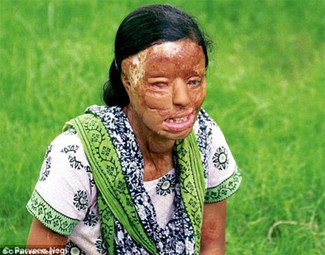 Người phụ nữ bị tạt axit tới biến dạng khuôn mặt vì dám từ chối kết hôn, 14 năm sau, điều kỳ diệu đã đến - Ảnh 3.